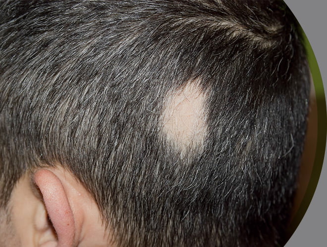 Tratamento para Alopecia com células troncos e Causas 1 tratamento para alopecia